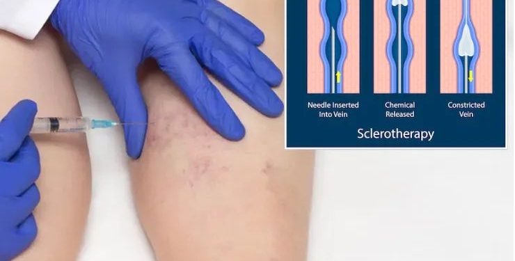 Varicose Vein Treatment in Singapore: A Comprehensive Guide